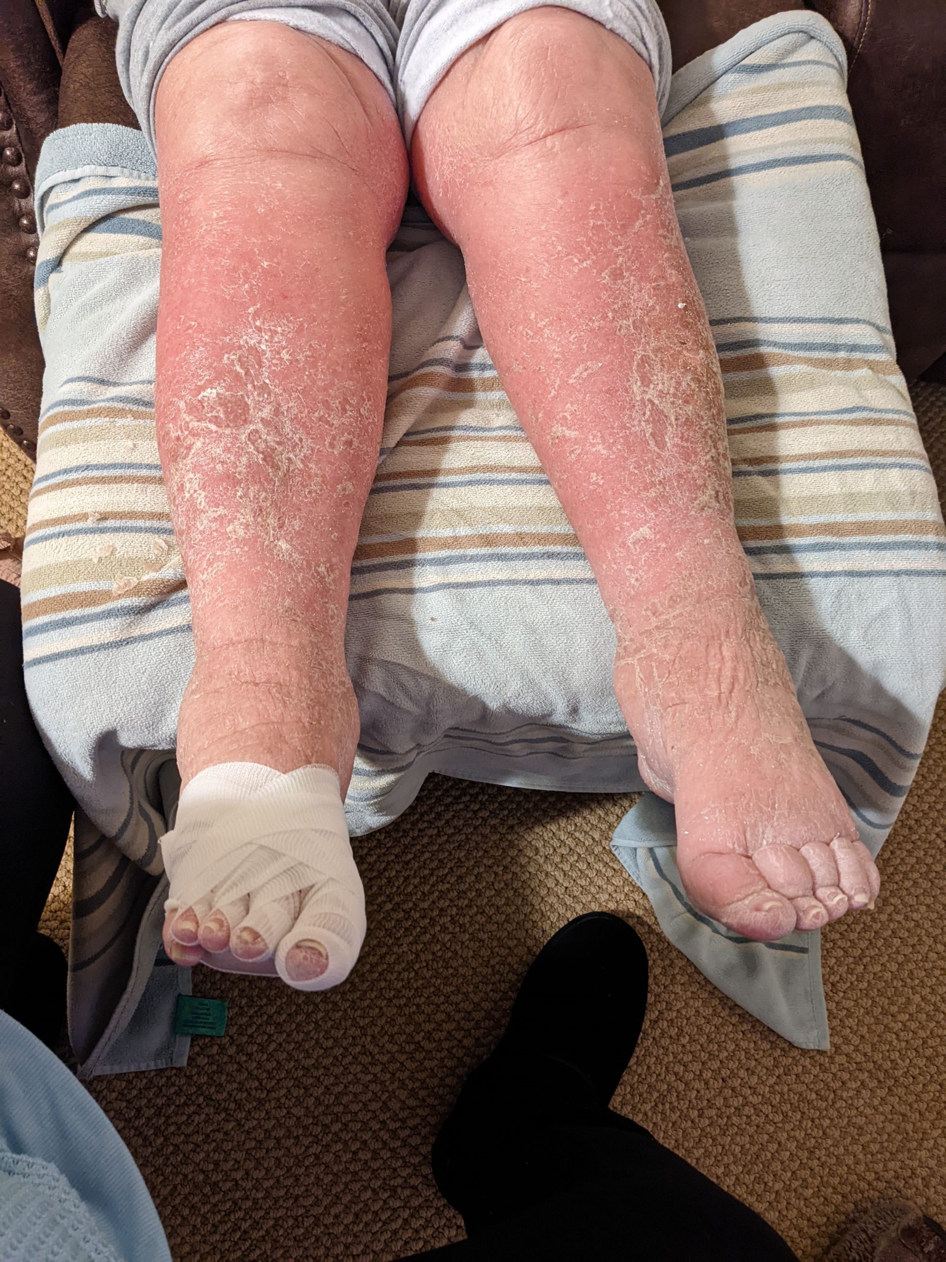 lymphedema pic